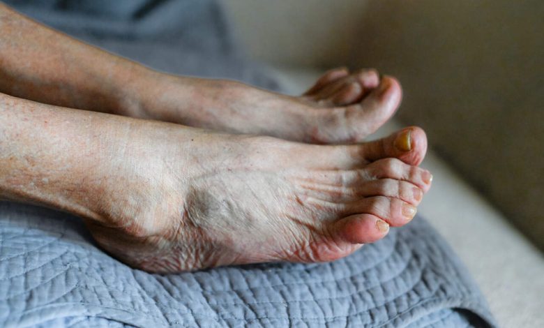 Cuidados com o pé diabético